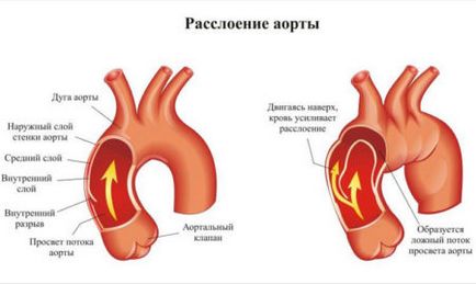 Compactarea rădăcinii aortice