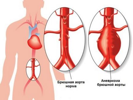 Ущільнення кореня аорти