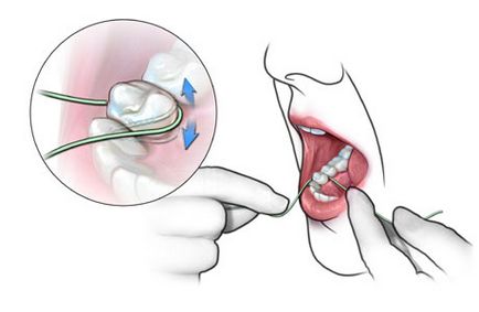 Догляд за порожниною рота після імплантації зубів, центр стоматології «Лускунчик» санкт-петербург