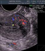 Узі органів малого таза в клініці Бутова, гінекологічне узі