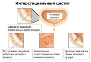 Tipuri de cistite lente, non-bacteriale, mecanice