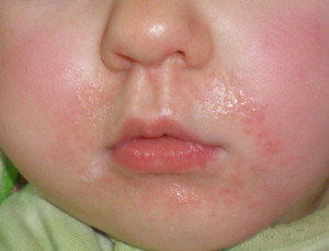 Influența stării intestinului asupra acneei, dermatolog