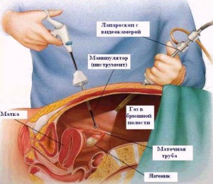 Позаматкова вагітність лапароскопічна операція