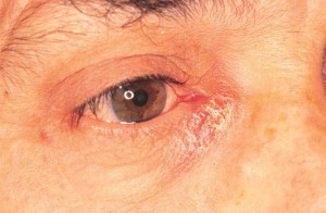 Inflamația simptomelor, tratamentului sacului lacrimal (dacryocistă)