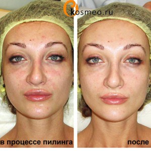 Revizuirea celulelor chimice de peeling c, revizuirea fotografiei, fotografie înainte și după, - blogul femeilor despre frumusețe și sănătate