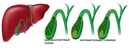 Холецистит симптоми лікування