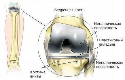 Durerea cronică în articulația genunchiului, întinderea ligamentelor cauzei, diagnosticul, tratamentul