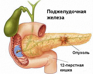 Tumorile maligne ale sistemului digestiv - cauze, simptome și tratament