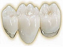 Coroane dentare