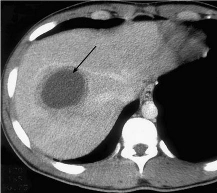 Абсцес печінки симптоматика, форми і лікування