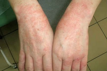 Alergia la soare - simptome și tratament, fotografie