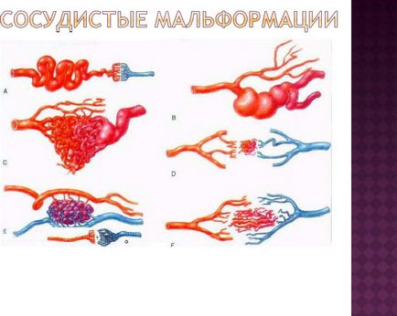 Arforminoase malformație a măduvei spinării