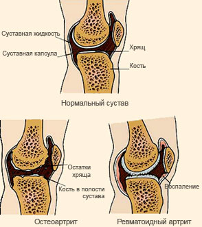 Tratamentul artritei și simptomele