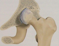 Асептичний некроз головки стегнової кістки (АНГБК) - ціни на лікування, симптоми і діагностика АНГБК