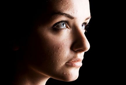 Puncte albe pe față - tipuri și caracteristici ale tratamentului