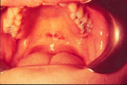 Ce este mononucleoza infecțioasă?