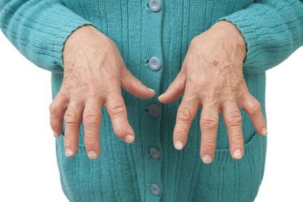 Ce este artrita reumatoidă tratată cu metode moderne noi, recomandări clinice