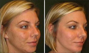 Що таке саліциловий пілінг для обличчя показання і протипоказання, результати і відгуки косметологів