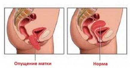 Ulcerul cervical decubital