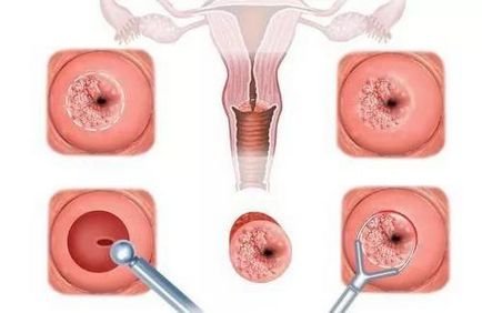 Ulcerul cervical decubital