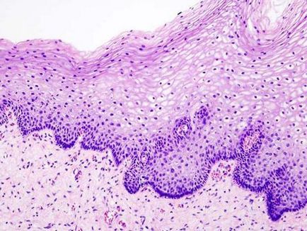 Ulcerul cervical decubital