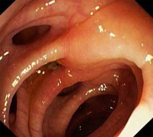 Diverticulul esofagului, diagnosticul și tratamentul bolii în Israel