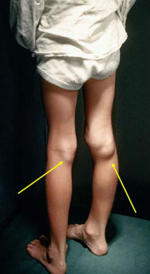 Доброякісна пухлина в колінному суглобі - кіста Бейкера
