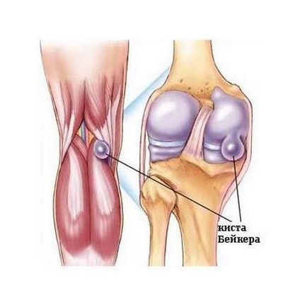 Доброякісна пухлина в колінному суглобі - кіста Бейкера