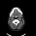 Ектопія щитовидної залози (lingual thyroid) сайт практичного рентгенолога - рентгенологія,