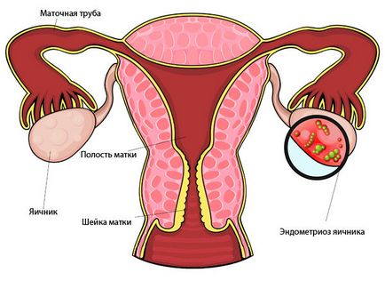 Endometrioid petefészek ciszta okok, tünetek és a kezelés (oka) Endometrioid petefészek ciszta okoz, tünetek és a kezelés