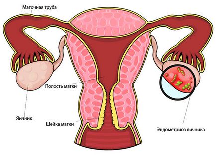 Chistul ovarian endometrioid provoacă, simptome și tratament