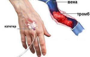 Venetele de flebită la tratamentul brațului