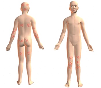 Herpetiform dermatitis duhringa simptome, tratament, diagnostic