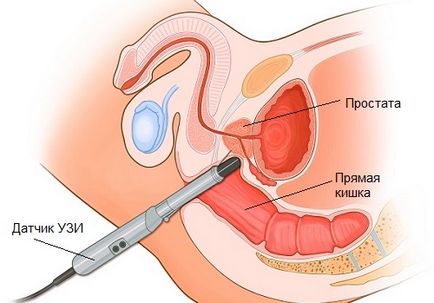 Hipertrofia prostatei ce este și ce este periculos