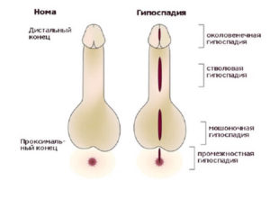 Hypospadias a fiúk fotó, capitatum forma, az üzemeltetés, a költségek és vélemények