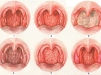 Gége angina simtomy, kezelése, diagnózisa