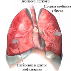 Rezultatele tratamentului abceselor odontogene - bisturiu - informații medicale și portal educațional