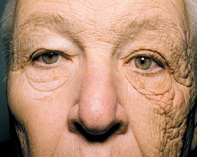 Cum de a preveni ridurile faciale ale unei persoane - opriți îmbătrânirea unei persoane
