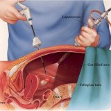 Cum funcționează operația laparoscopică - bisturiu - informație medicală-educativă