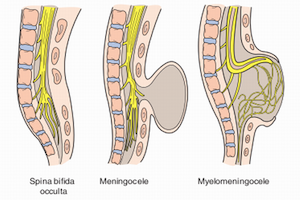 Hogyan nyilvánul meg az okkult spina bifida gyermek és felnőtt