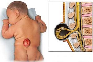 Hogyan nyilvánul meg az okkult spina bifida gyermek és felnőtt