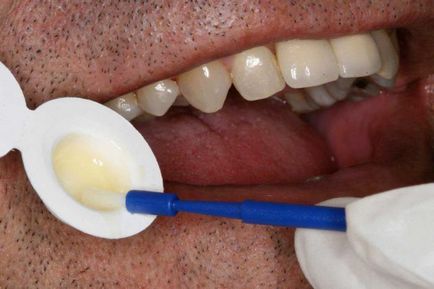 Кальцій глюконат відбілювання зубів