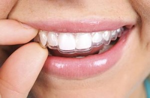 Капа для зубів особливості і застосування - можливо кращий сайт про лікування зубів