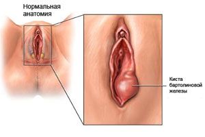 Chistul glandei bartholinice - cauze, simptome și îndepărtarea chistului glandei bartholinice