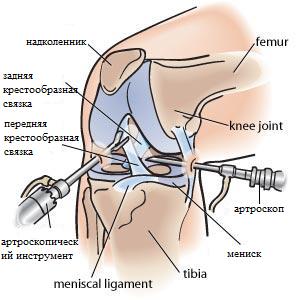 Кіста Бейкера колінного суглоба - лікування і профілактика