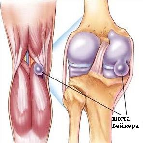 Chistul genunchiului osoan - tratament și prevenire