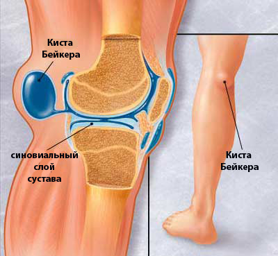 Кіста Бейкера колінного суглоба - лікування і профілактика