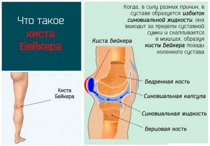 Кіста Бейкера колінного суглоба, причини і лікування, розміри для операції