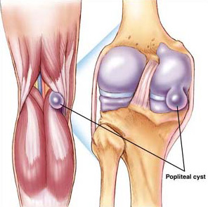 Chistul articular, simptomele, tratamentul