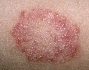 Foto roșu lichen fotografie, tratament, simptome la om